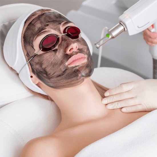 Hollywood – carbon Peel