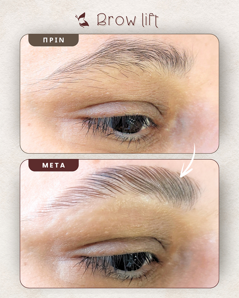 browlift υπηρεσία δέρματολογίας